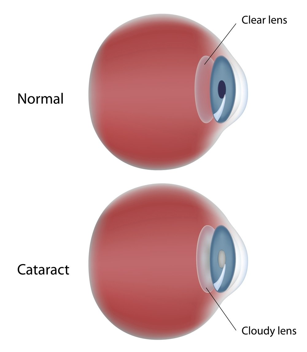 Corneal Transplant at New Al Shefa Clinic