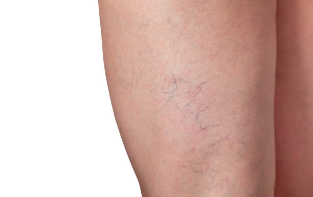 Spider Veins Treatment Dubai for Clear Skin