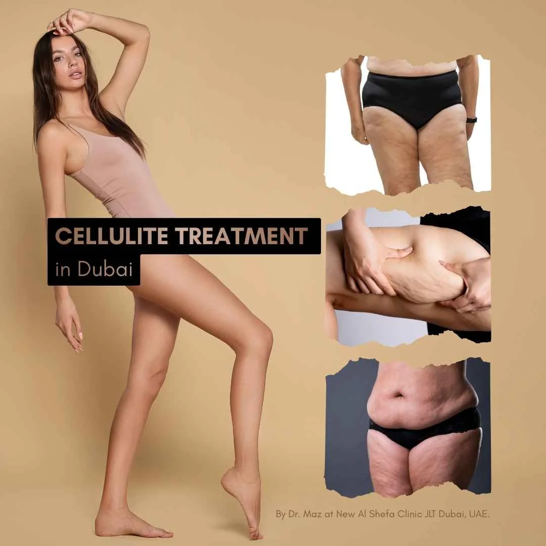 cellulite treatment